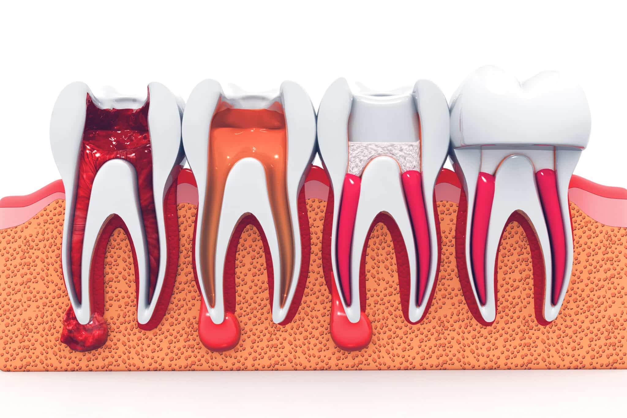 Different Stages of Teeth Root Canals