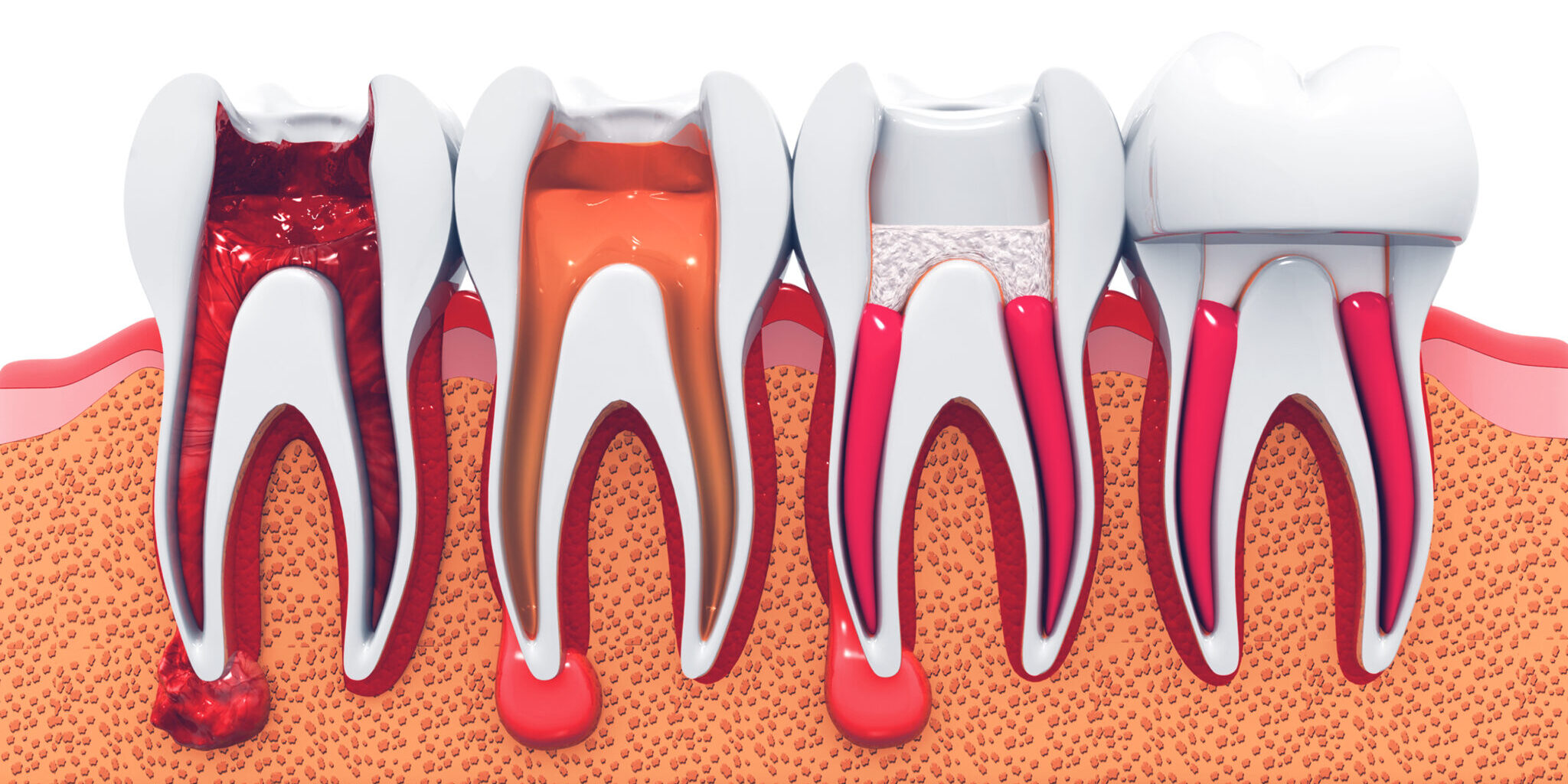 Evo root canal